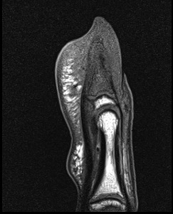 Figure 3 for case Osteoid osteoma ( RID4005 )